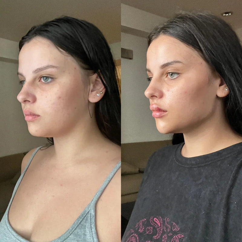 Nuvio Vegan Micro-Infusion Treatment